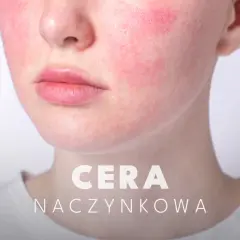 Czego unikać przy cerze naczynkowej, aby uniknąć podrażnień i zaczerwienień