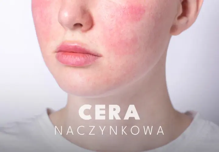 Czego unikać przy cerze naczynkowej, aby uniknąć podrażnień i zaczerwienień