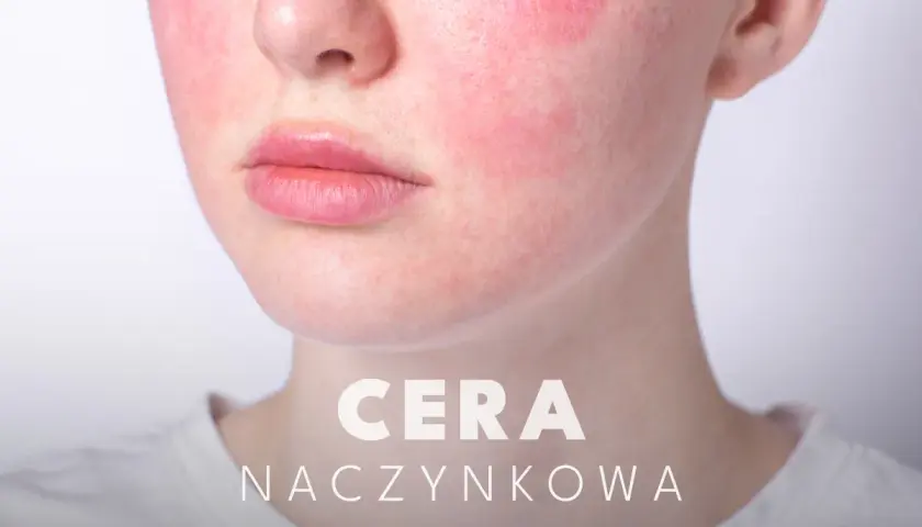 Czego unikać przy cerze naczynkowej, aby uniknąć podrażnień i zaczerwienień