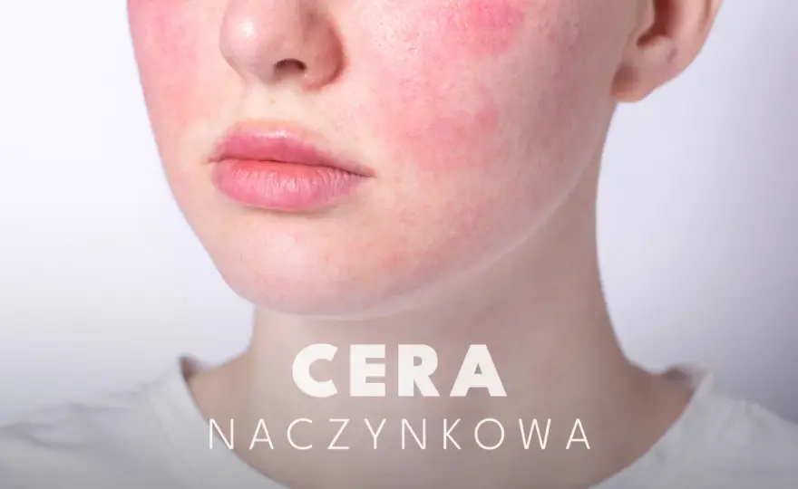 Czego unikać przy cerze naczynkowej, aby uniknąć podrażnień i zaczerwienień